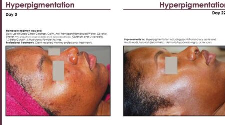 Osmosis Facial for Hyperpigmentation African American Skin - West Lake Aesthetics and Wellness