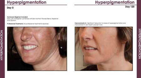 Osmosis Facial for Hyperpigmentation West Lake Aesthetics and Wellness