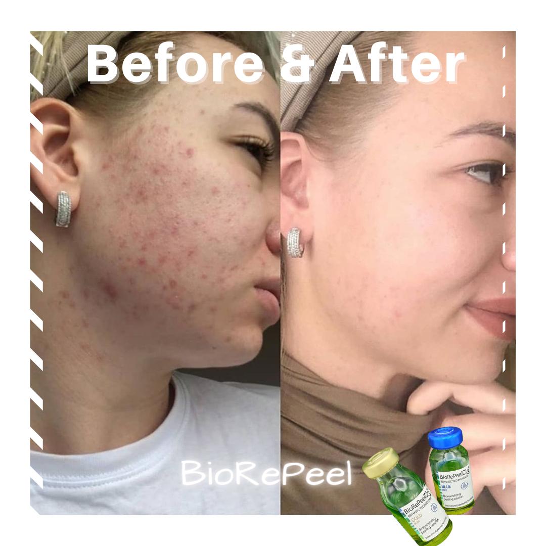 Bio RePeel Acne Before & After